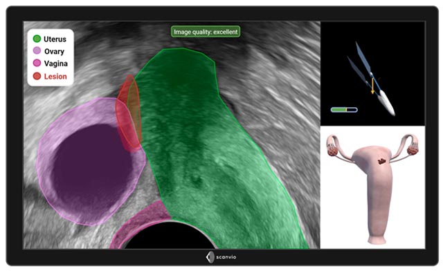 Ist es Endometriose? Ultraschall-Darstellung eines weiblichen Unterleibs. Foto: zVg